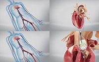 医学三维动画：三维手术模拟动画